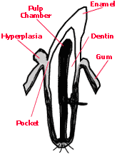 Graphic of Dental Resorptive Lesions